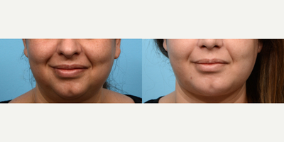 25-34 year old woman treated with Chin Implant, Chin Liposuction - Dr. Wise performed a chin augmentation along with submental liposuction on this 33-year-old patient. 8 weeks post-op the patient looks great and loves the outcome!