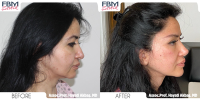 45-54 year old woman treated with Deep Plane Facelift, Neck Lift, Eyelid Surgery, Cheek Lift, Facial Fat Transfer, Canthoplasty - 45-54 year old woman treated with Deep Plane Facelift, Neck Lift, Eyelid Surgery, Cheek Lift, Facial Fat Transfer and Canthoplasty2 years post operation