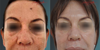 55-64 Years Old Woman Treated with Mole Removal - The final state of our patient, whose mole removal process was completed from the forehead area; it is in the appendix.