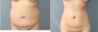 18-24 year old woman treated with Liposuction - 360 lipo +bbl