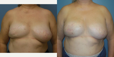 55-64 year old woman treated with Breast Reconstruction - 4 Fat Transfers to Right Reconstructed Breast, 3.5 years Post Op from first fat transfer