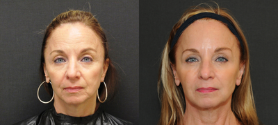 55-64 year old woman treated with Sculptra - Pt had Sculptra, Restylane Silk, and Botox