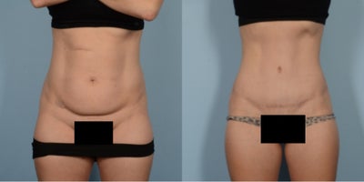 35-44 year old woman treated with Tummy Tuck - 505 grams removed