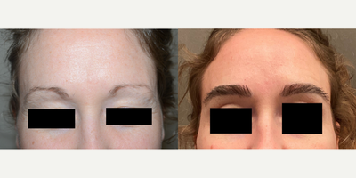 35-44 year old woman treated with Eyebrow Transplant - Result of eyebrow transplant 750 grafts