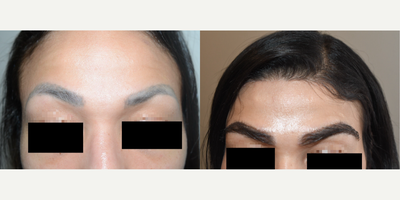 25-34 year old woman treated with Eyebrow Transplant - Result of eyebrow transplant 750 graftsChallenging case due to the thickness of her donor hairs, this 32yo achieved fuller eyebrows with a transplant.