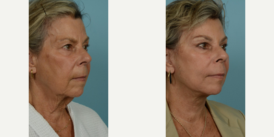 65-74 year old woman treated with Facelift, SMAS Facelift, Neck Lift, Eyelid Surgery, Brow Lift, Facial Fat Transfer, Laser Resu - At the vibrant age of 71, this patient elected to undergo several procedures with Dr. Thomas Mustoe to preserve her natural beauty and active lifestyle without an overly tight or pulled appearance. Her personalized facial rejuvenation included a deep plane facelift/minilift, neck lift, upper blepharoplasty, brow lift, and fat grafting around the mouth, all performed by the skilled hands of Dr. Mustoe in Chicago. Post-procedure results, observable just one month post-op, reflect her desire for a subtle but impactful alteration, enhancing her already attractive features while maintaining her characteristic expressions.The above patient sought to leverage Dr. Mustoe's proficiency not only in facelift/minilift techniques but also in neck lift, blepharoplasty, brow lift, and fat grafting procedures. In addition to these, laser treatment and dermabrasion were used to augment the smoothness and youthfulness of her skin near the mouth area. The successful outcome demonstrates Dr. Mustoe's commitment to meeting the patient's unique requirements. Despite her age, the patient continues to lead a vibrant life post-procedure, which highlights minimal impact on her active lifestyle due to Dr. Mustoe's careful and thoughtful approach.Known for his personalized approach and optimal results, Dr. Thomas Mustoe is an American board-certified plastic surgeon and a respected authority in the field. Renowned for conducting over 10,000 operations, Dr. Mustoe's practice, TLKM Plastic Surgery, located at 737 North Michigan Ave., Chicago, offers innovative and age-defying techniques, including the facelift/minilift procedure. The patient's experience showcases Dr. Mustoe's ability to balance surgical control and aesthetic sensitivity to deliver naturally beautiful results that satisfy the patient's desires while preserving their unique identity.