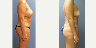 Liposuction Results for this 40-year-old Woman - Tummy Tuck, Breast Implant Removal, Capsulectomy, Liposuction (Flanks) and Fat Transfer (Thigh) for this 40-year-old woman