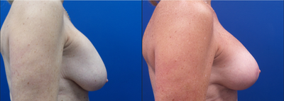 55-64 year old woman treated with Mentor Breast Implants - 60-year-old patient underwent wise pattern revision mastopexy (breast lift) and breast implant exchange with Mentor smooth round 230cc moderate profile saline implants.