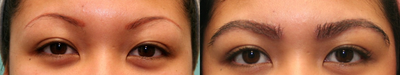 25-34 year old woman treated with Eyebrow Transplant - 230 hair grafts per brow
