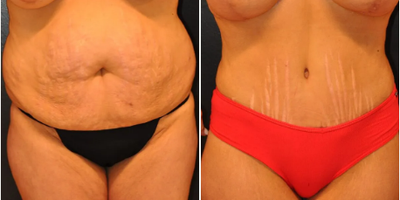 Woman treated with Tummy Tuck - Woman treated with Tummy Tuck