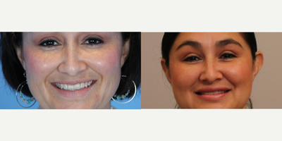 Meaningful Beauty - Meaningful Beauty and&nbsp;Filler Treatment to the Lips