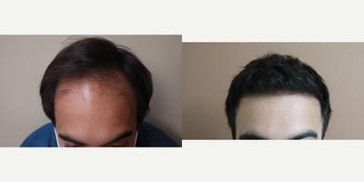 35-44 year old man treated with FUE Hair Transplant - This patient underwent FUE hair transplant with 3000 grafts.