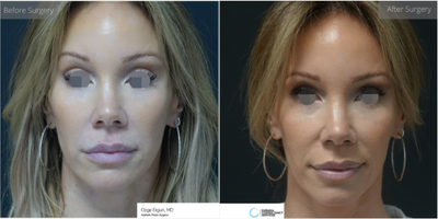 35-44 year old woman treated with Lip Lift - Lip Lift Surgery