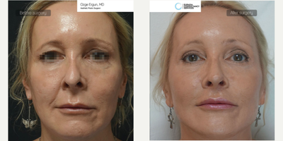 45-54 year old woman treated with Lip Lift - Lip Lift Surgery