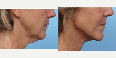 45-54 year old woman treated with Facelift - A patient from Temecula Valley. After facelift, note the further defining the jowls along the jawline, softening the marionette lines from the corner of the mouth to the jaw, and sharpening of the neckline.