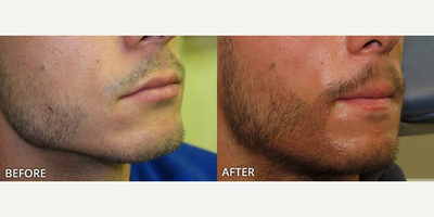 Man treated with Beard Transplant - Man treated with Beard Transplant