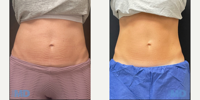 25-34 year old woman treated with Emsculpt NEO - This patient received 6 EMSCULPT NEO treatments.