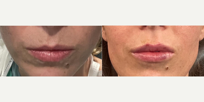 Woman treated with Restylane, Restylane Kysse, Dermal Fillers, Juvederm - Lips come in all shapes and sizes; sometimes theyre symmetrical and sometimes we need to even things out a bit. This patient wanted to even out her lips but keep a pretty natural appearance. She always had a small upper lip so we concentrated on improving that as well as improving the symmetry. 24 hours later we can start to see the results she will have from the selfie she sent....For lip injections I offer both Restylane as well as specific Juvederm products to tailor patients results to exactly what they are looking for; anything from a lightly hydrated look all the way up to BIG.