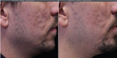 Man treated with UltraClear Laser - Man treated with UltraClear Laser
