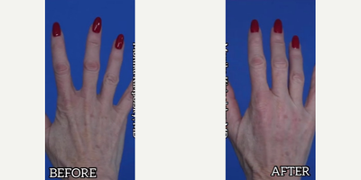 Woman treated with Hand Rejuvenation - Woman treated with Hand Rejuvenation, Dermal Fillers