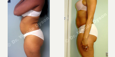 25-34 year old woman treated with Zerona - 6-9 treatments of Zerona Lipolaser.
