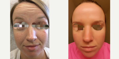 35-44 year old woman treated with Vampire Facelift - 3 weeks after Botox, Juveder Ultra Plus, and PRP injections (Vampire Facelift). 6mo later, no make up.