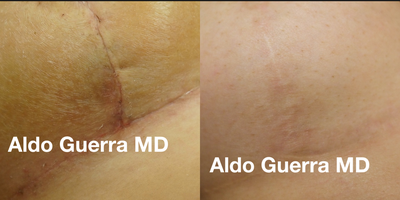 25-34 year old woman treated with Embrace Scar Therapy - Before and after embrace Active Scar treatments for verticle breast lift incision.
