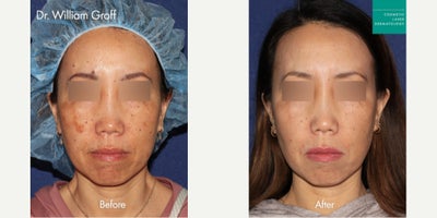 Fraxel and Alexandrite Laser for Dark Spots by Dr. Groff - Fraxel and Alexandrite Laser for Dark Spots by Dr. Groff
