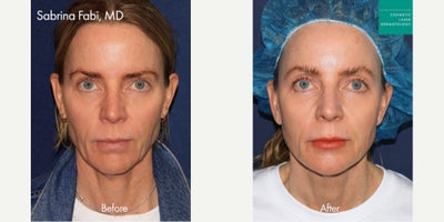 Sculptra, Nueromodulators, Filler and Take10 by Dr. Fabi - Sculptra, Nueromodulators, Filler and Take10 by Dr. Fabi
