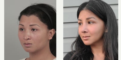 25-34 year old woman treated with AccuLift, Cheekbone Reduction, Facial Fat Transfer, Ptosis Surgery, Rhinoplasty, V Line Surger - .