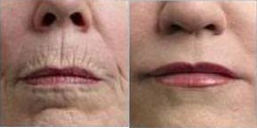 45-54 year old woman treated with Microneedling - Patient treated with full face microneedling with our DermaPen.