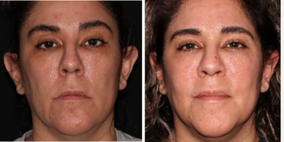 45-54 year old woman treated with Pearl Laser - This patient received the Pearl Laser Resurfacing treatment - it has been two weeks since her procedure. Her tone and pore size have considerably improvedand she will continue to see more results - we will post more pics. This procedure is great for texture, pore size, acne scars and uneven tone.