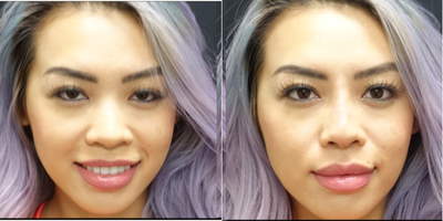 25-34 year old woman treated with Non Surgical Nose Job - The patient had a non-surgical rhinoplasty. Restylane was used to improve the overall appearance of her nose. The filler was used to give the nose a narrower and more sleek appearance. It was also used to enhance her nasal tip and improve the contour of the nasal bridge. The filler is a great options as it can be done in the office in twenty minutes.