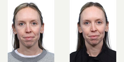 Woman treated with PicoWay, Ultralase, Vampire Facial - Woman treated with PicoWay, Ultralase, Vampire Facial