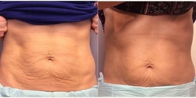 Woman treated with TempSure Envi - Woman treated with TempSure Envi.