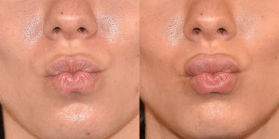 18-24 year old woman treated with Lip Fillers, Juvederm, Vollure - 1mL to lips