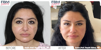 45-54 year old woman treated with Deep Plane Facelift, Neck Lift, Eyelid Surgery, Cheek Lift, Facial Fat Transfer, Canthoplasty - 45-54 year old woman treated with Deep Plane Facelift, Neck Lift, Eyelid Surgery, Cheek Lift, Facial Fat Transfer and Canthoplasty2 years post operation