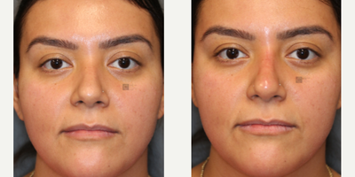 Filler Rhinoplasty - Filler Rhinoplasty.