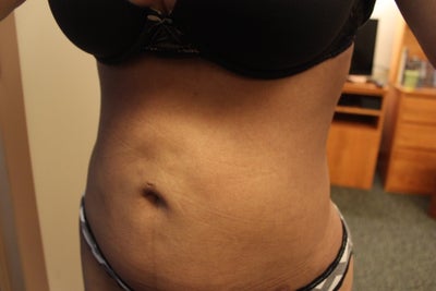 after lipo abdomen permanent fixed discoloration dents weeks op small fort md washington ago years