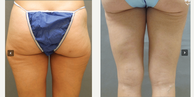 Woman treated with Tummy Tuck - Woman treated with Tummy Tuck