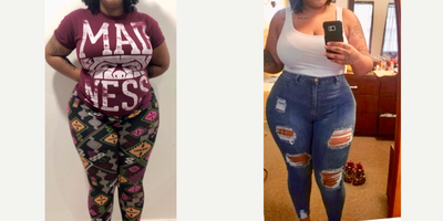 35-44 year old woman treated with Tummy Tuck, Liposuction, Brazilian Butt Lift - Excellent outcome after full intense liposuction including abdomen, waist, laterals and upper and lower back to improve your body contour and get better curves, especially in your waist area and dominican butt lift.