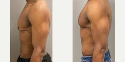 25-34 year old man treated with Male Tummy Tuck, Gynecomastia Surgery, Masculinizing Top Surgery - 30 yo male s/p modified mastopexy for gynecomastia after massive weight loss and male tummy tuck performed in our on site AAAA certified operating suite