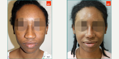 [African American Rhinoplasty] 25-34 year old woman treated with African American Rhinoplasty - 100% Rib cartilage Rhinoplasty with Mid Face Augmentation