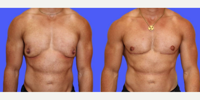 Man treated with Masculinizing Top Surgery - Man treated with Masculinizing Top Surgery