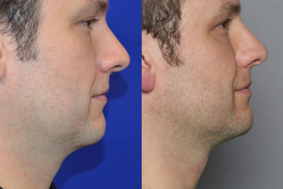 Man treated with Injectable Fillers - Man treated with Injectable Fillers. This patient presented wanting to improve the look of his neck/jawline and reduce fat at the area. After visiting with Dr. Ho, patient elected to have a Kybella treatment.