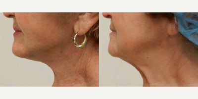 Neck Lift - The Art of Plastic Surgery, Dr. Gregory A. Wiener, MD FACS