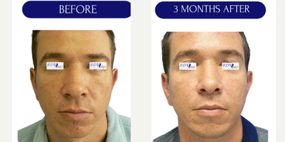 55-64 year old man treated with Radiesse, Dermal Fillers, Collagen Injection, Skin Tightening, Skin Rejuvenation, Sculptra, Nons - Collagen biostimulation with DILUTED RADIESSEHyperdiluted Radiesse is Radiesse that has been diluted with a mixture of sterile saline solution and lidocaine. This makes it an easily spreadable bio stimulator capable of remodeling skin over a larger area. Hyperdiluted Radiesse is injected into areas of the skin that are loose as opposed to firm and stimulates the body to create new collagen. It is used to address concerns related to skin texture and laxity, such as fine wrinkles, creepiness, acne scars, cellulite, and saggy skin.