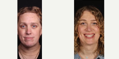 35-44 year old woman treated with Facial Feminization Surgery, Brow Lift, Forehead Reduction, Rhinoplasty, Facial Fat Transfer,  - Facial feminization surgery (FFS) is a customizable operative plan that normally involves multiple procedures within one aesthetic.  Thank you to our patient for letting us share her facial feminization surgery experience with us, now 8 months post-op.