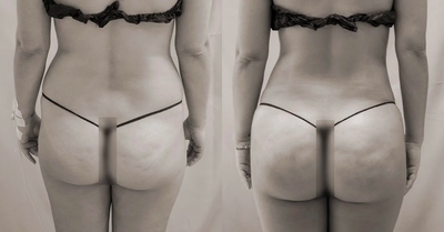 Brazilian Butt Lift - Brazilian Butt Lift