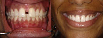 Treatment of gapp teeth with Invisalign - 
	Invisalign treatment to close up gap: 5 months.

